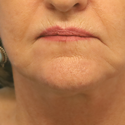 Mini Facelift Before & After Patient #6862