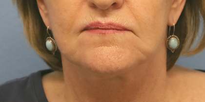 Mini Facelift Before & After Patient #6862