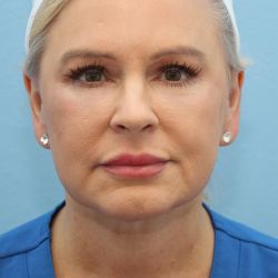 Juvederm Voluma Before & After Patient #6867