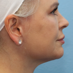 Mini Facelift Before & After Patient #6867