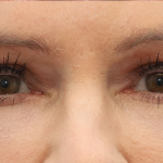 Lower Blepharoplasty Before & After Patient #6872