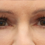 Upper Blepharoplasty Before & After Patient #6872