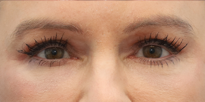 Lower Blepharoplasty Before & After Patient #6872