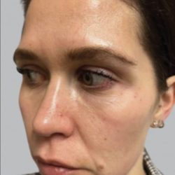 Cellenis PRP Before & After Patient #6949