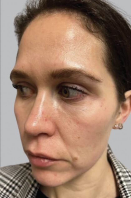 Cellenis PRP Before & After Patient #6949