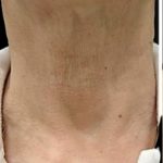 Cellenis PRP Before & After Patient #6950