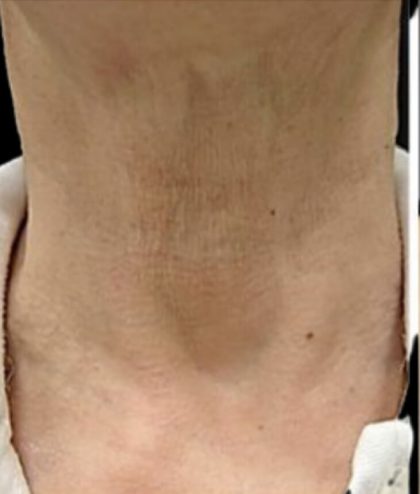 Cellenis PRP Before & After Patient #6950