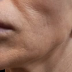 Cellenis PRP Before & After Patient #6957