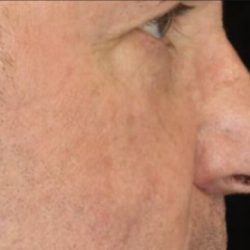 Cellenis PRP Before & After Patient #6958
