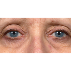 Thermage Before & After Patient #7491