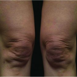 Thermage Before & After Patient #7492