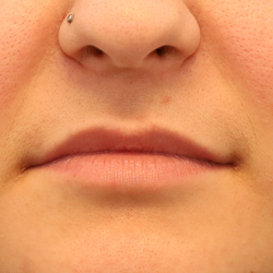 Volumize Before & After Patient #7584
