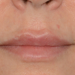 Volumize Before & After Patient #7581