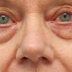 Lower Blepharoplasty Before & After Patient #7596
