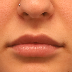 Volumize Before & After Patient #7584