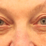 Blepharoplasty Before & After Patient #7744