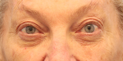 Blepharoplasty Before & After Patient #7744