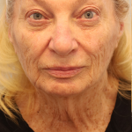 Mini Facelift Before & After Patient #7739