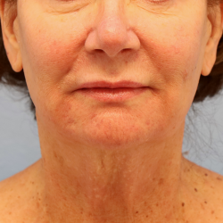 Mini Facelift Before & After Patient #7747