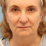 Mini Facelift Before & After Patient #7752