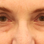 Brow Lift Before & After Patient #7755