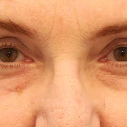 Brow Lift Before & After Patient #7755