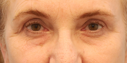 Brow Lift Before & After Patient #7755