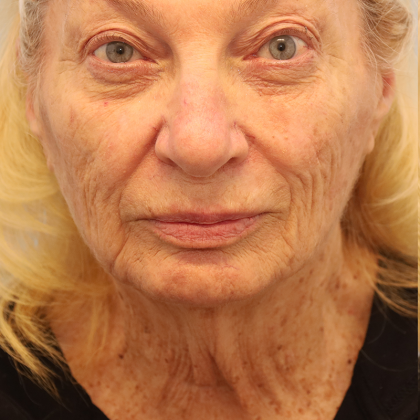Mini Facelift Before & After Patient #7739