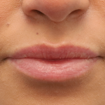 Juvederm Volbella Before & After Patient #7759