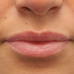 Juvederm Volbella Before & After Patient #7759