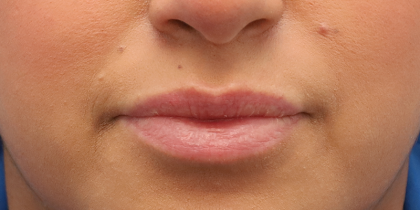 Juvederm Volbella Before & After Patient #7759
