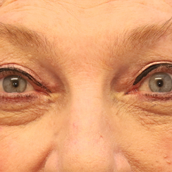 Blepharoplasty Before & After Patient #7744