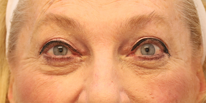 Blepharoplasty Before & After Patient #7744