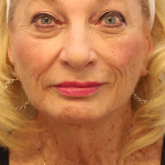 Mini Facelift Before & After Patient #7739