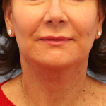 Mini Facelift Before & After Patient #7747