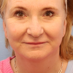 Mini Facelift Before & After Patient #7752