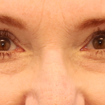 Brow Lift Before & After Patient #7755