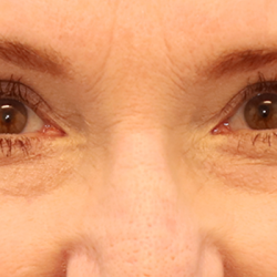 Brow Lift Before & After Patient #7755
