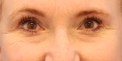 Brow Lift Before & After Patient #7755