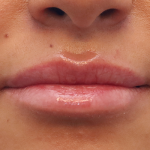 Juvederm Volbella Before & After Patient #7759