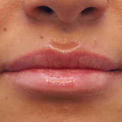 Juvederm Volbella Before & After Patient #7759