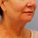 Mini Facelift Before & After Patient #7747
