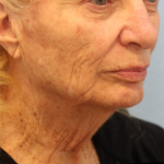 Mini Facelift Before & After Patient #7739