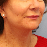 Mini Facelift Before & After Patient #7747