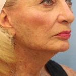Mini Facelift Before & After Patient #7739