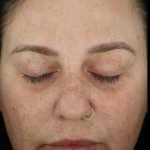 Microneedling Before & After Patient #7985