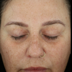 Microneedling Before & After Patient #7985