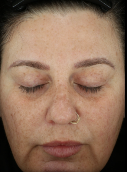 Microneedling Before & After Patient #7985