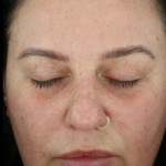 Microneedling Before & After Patient #7985