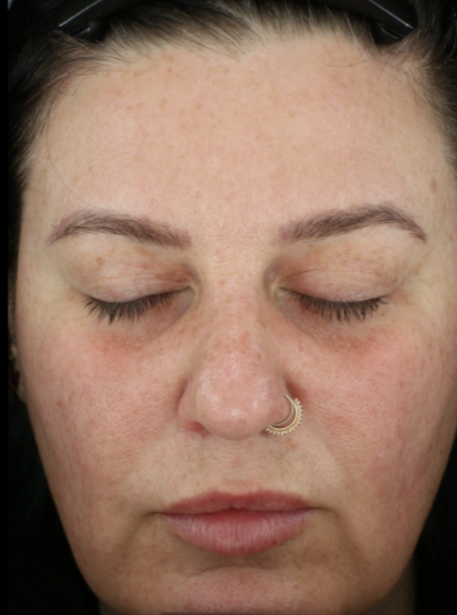 Microneedling Before & After Patient #7985